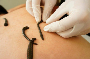 Leech Therapy in Ayurveda