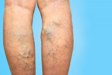 Varicose Vein and Its Ayurvedic Treatment