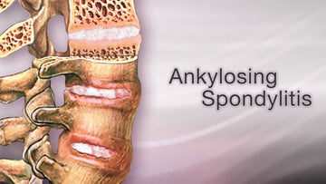 ANKYLOSING SPONDYLITIS AND ITS TREATMENT