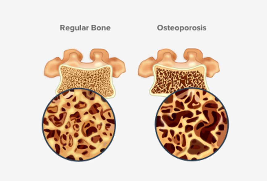 Osteoporosis and Massage: Etiology, Signs & Safety