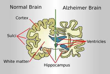 ALZHEIMER DISEASE