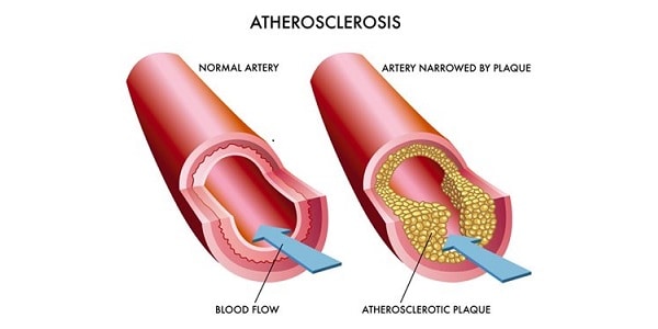 ATHEROSCHLEROSIS