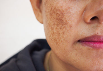 BLEMISHES
