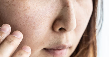 What is Blemishes? How Ayurveda is helpful in curing Blemishes Naturally?