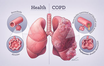 What is COPD? How to treat it naturally