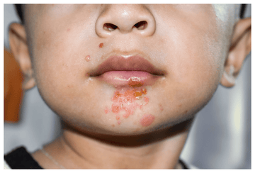 IMPETIGO