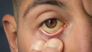 Jaundice
