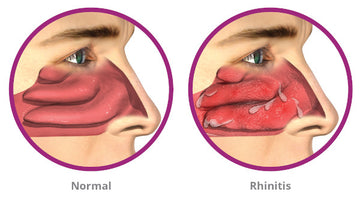 ALLERGIC RHINITIS