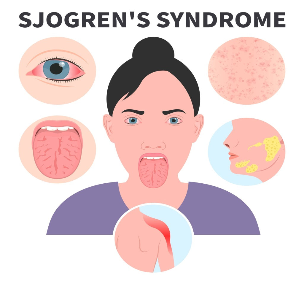 Sjogren’s Syndrome