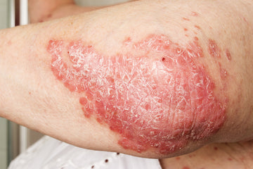 Case Study: Ruhi – Chronic Psoriasis