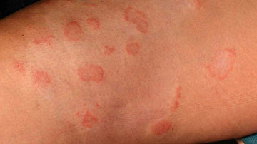 How to Treat Fungal Infection with the help of Ayurvedic Herbal Remedies?