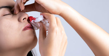 EPISTAXIS