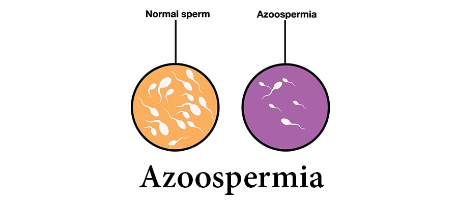 AZOOSPERMIA