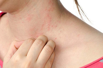 Hives (Urticaria)