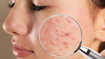 Curing Acne with Ayurveda