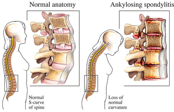 ANKYLOSING SPONDYLITIS