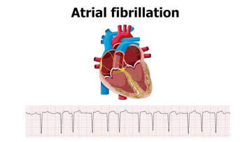 ATRIAL FIBRILLATION