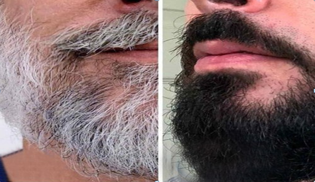 How To Reverse Grey Beard Naturally