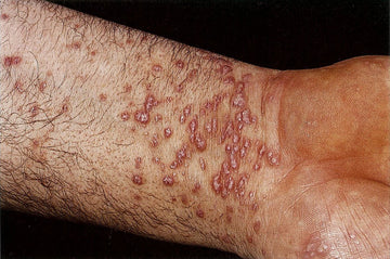 LICHEN PLANUS