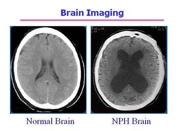 What is Normal Pressure Hydrocephalus? How it can be treated by Herbal Remedies?
