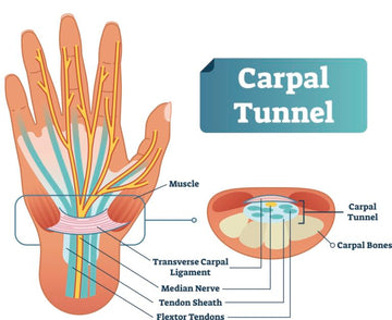CARPAL TUNNEL SYNDROME