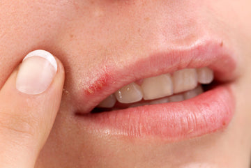 COLD SORES