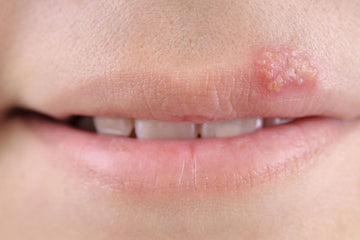 COLD SORES