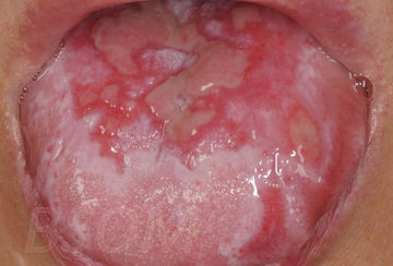 TOP 7 NATURAL REMEDIES FOR ORAL LICHEN PLANUS