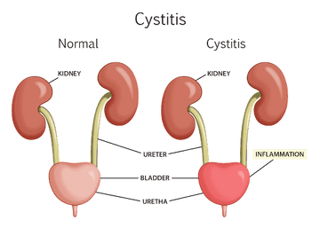 CYSTITIS