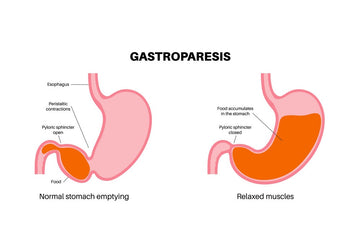 GASTROPARESIS