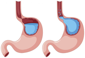 GERD (GASTROESOPHAGEAL REFLUX DISEASE)