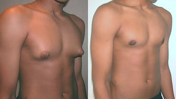 GYNECOMASTIA