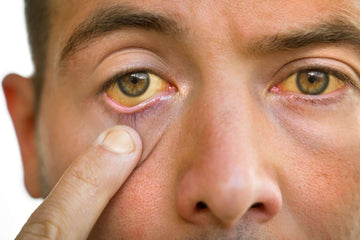 What is Jaundice? What are its Symptoms? How it can be treated by Herbal Remedies?