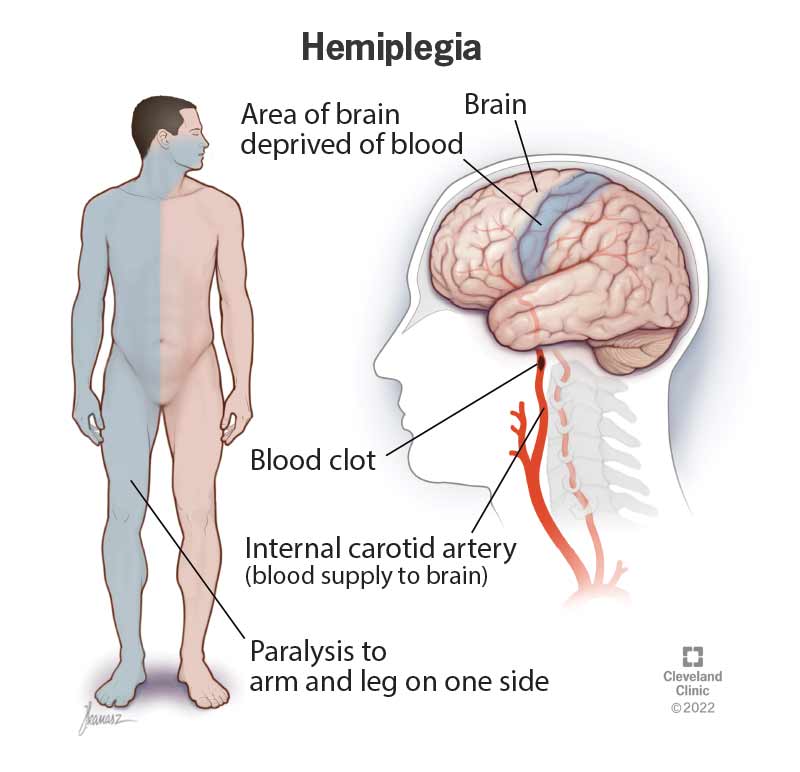 Hemiplegia hemiplegia