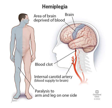 Hemiplegia