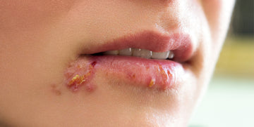 Herpes