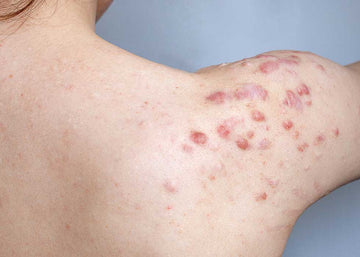 KELOID