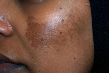 Melasma and Its Ayurvedic management