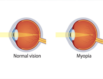 MYOPIA