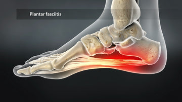 PLANTAR FASCIITIS