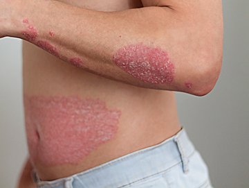 Psoriasis
