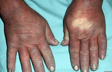 SCLERODERMA