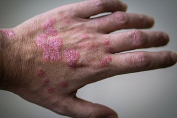 PSORIASIS