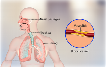 Wegener’s Disease
