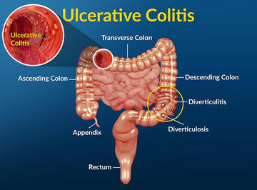 ULCERATIVE COLITIS