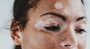 VITILIGO (SHWITRA)