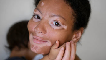 Leucoderma