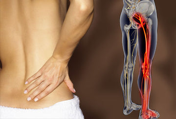 SCIATICA