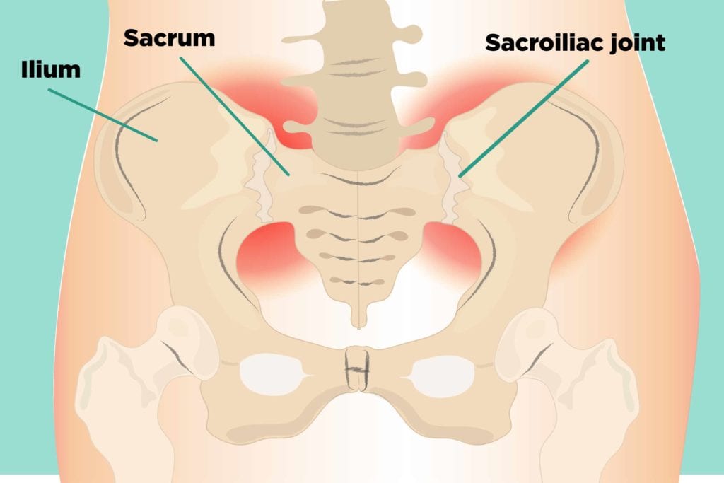 What is Bilateral Sacroiliitis? How it can be treated in Ayurveda?