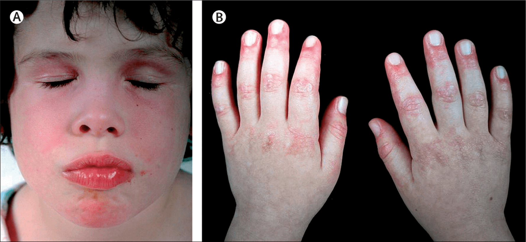 DERMATOMYOSITIS